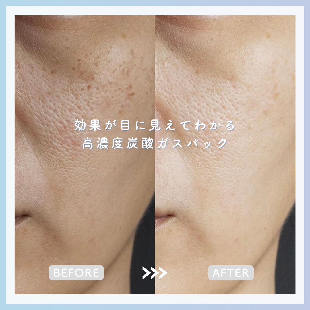 CO2トリートメント【カーボキシー炭酸パック】5回分