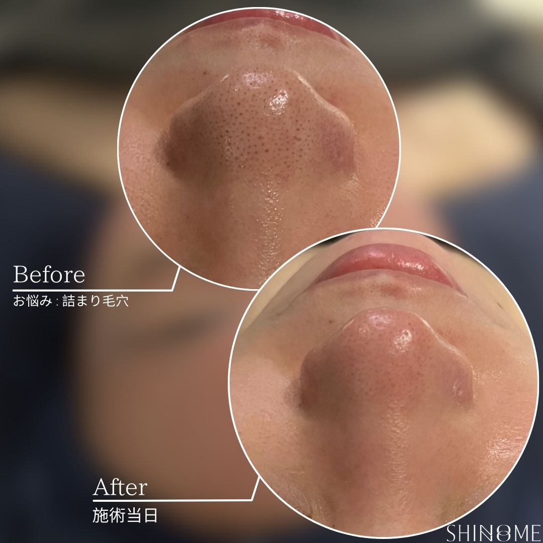 毛穴の詰まり症例写真。詰まり＆黒ずみケア